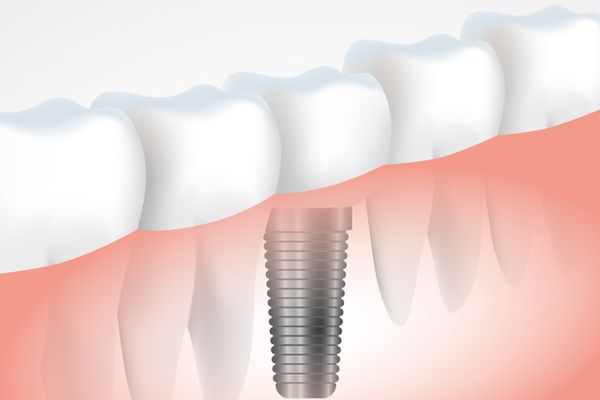 5 Claves para elegir tu implantólogo