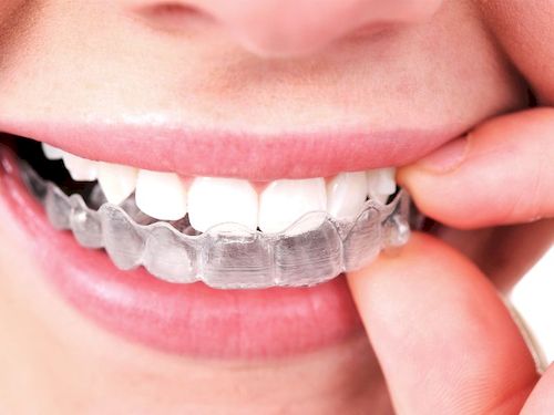 Conoces las fases del tratamiento con ortodoncia Invisalign