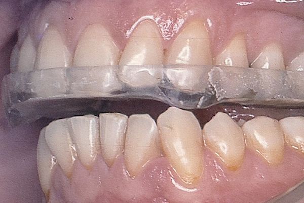 Férulas de descarga: ¿Cómo la cuido? - Clínica Dental Puerta de Toledo