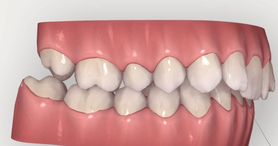 Qué son los microtornillos o microimplantes toledo