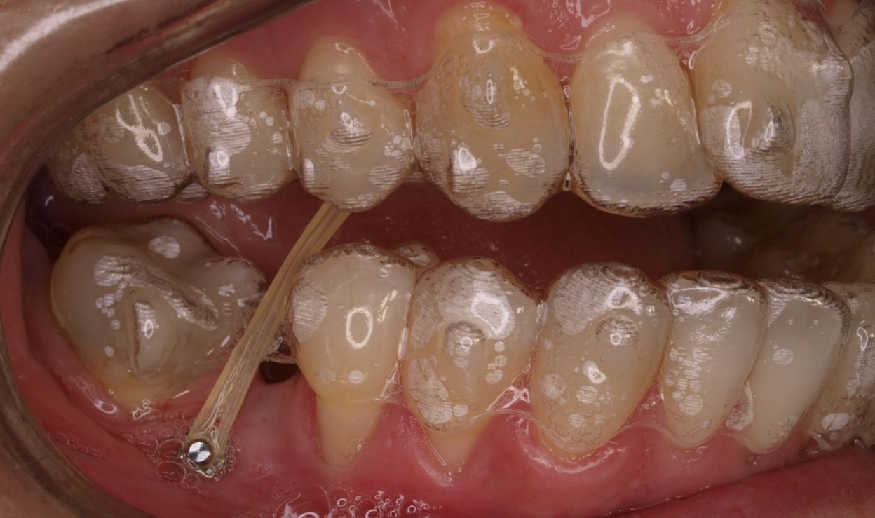 Qué son los microtornillos o microimplantes toledo