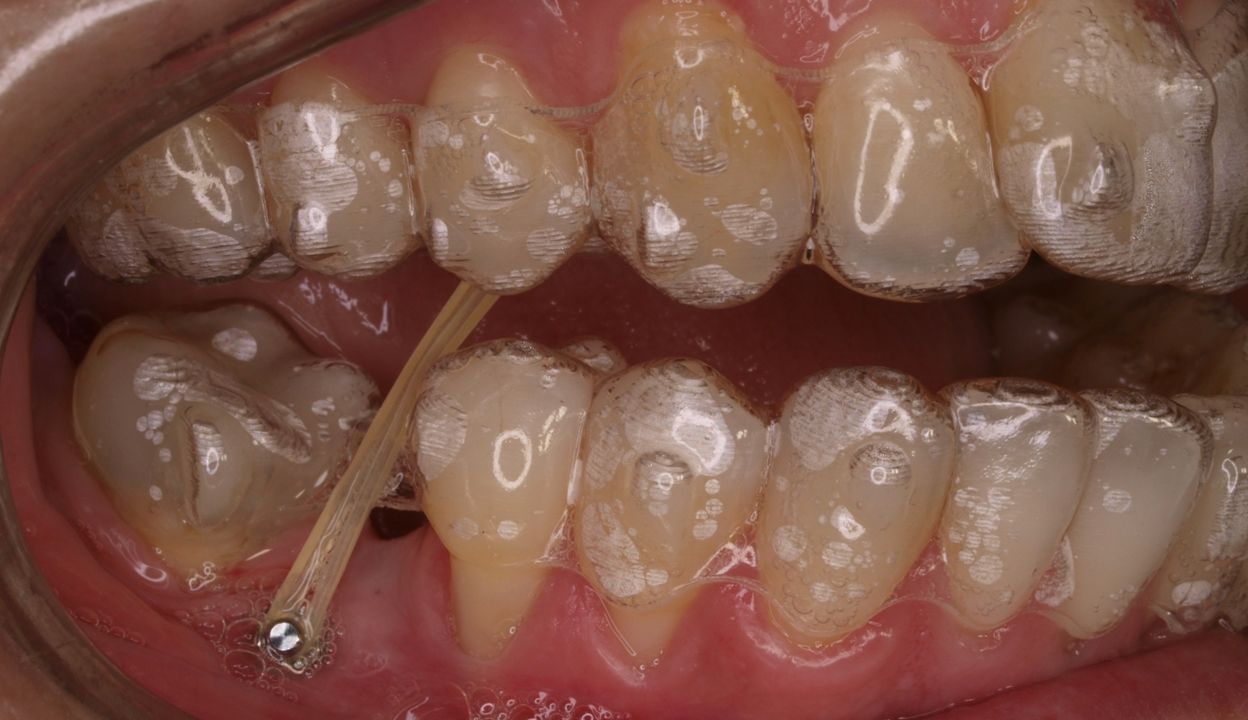 ¿Qué son los microtornillos o microimplantes?