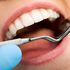 Ventajas de una limpieza dental profesional