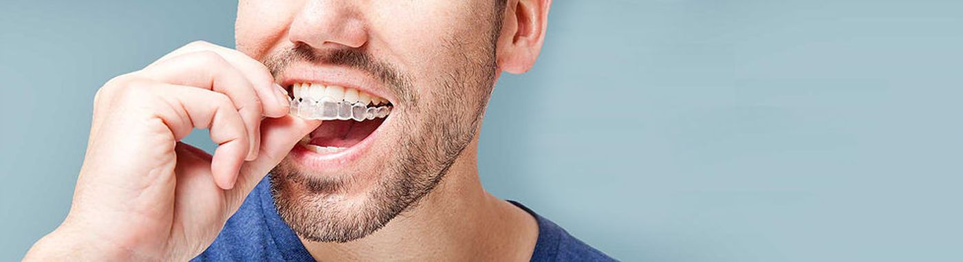 ventajas ortodoncia invisible implantes dentales