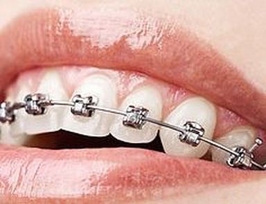 brackets autoligables