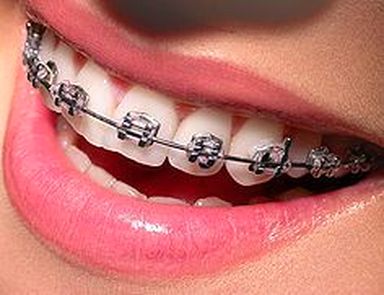 brackets metálicos